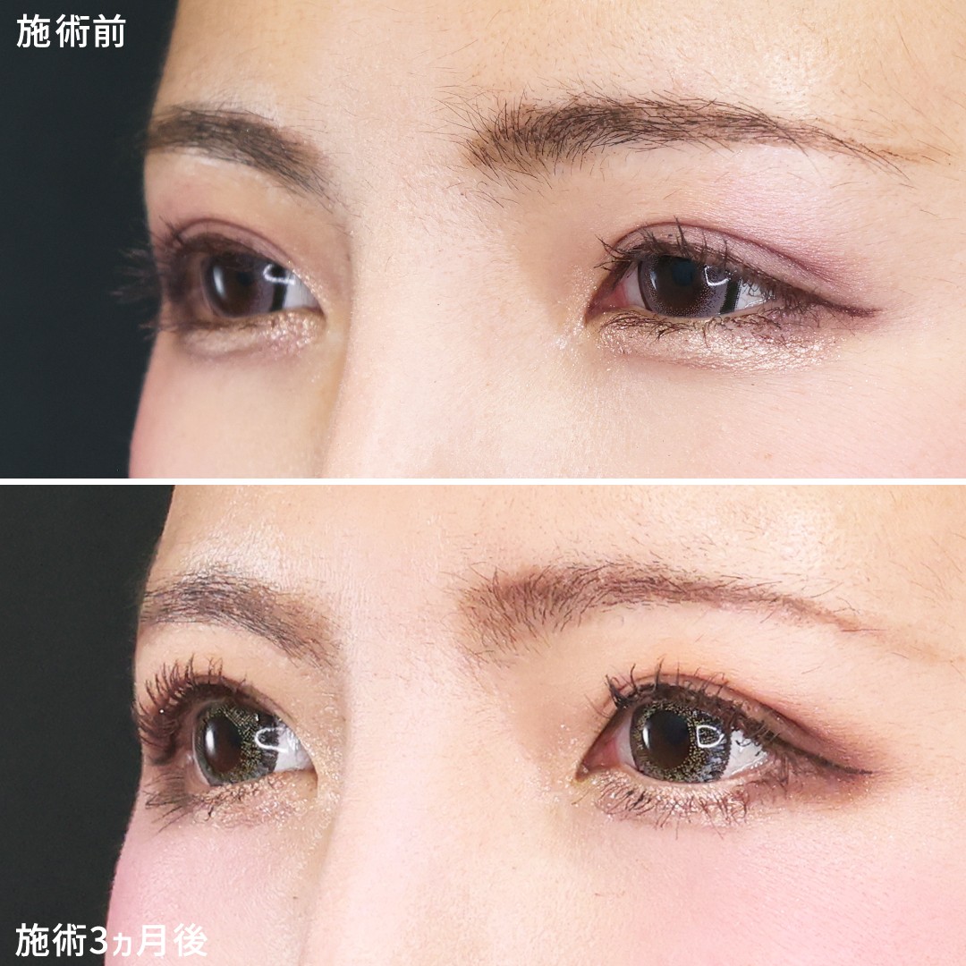 グラマラスライン（タレ目形成）の症例写真 施術前後 