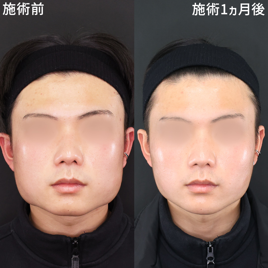 TAC式 ツヤ肌コラーゲンリフト®/エラボトックス注射/顎のヒアルロン酸注射の症例写真 施術前後 