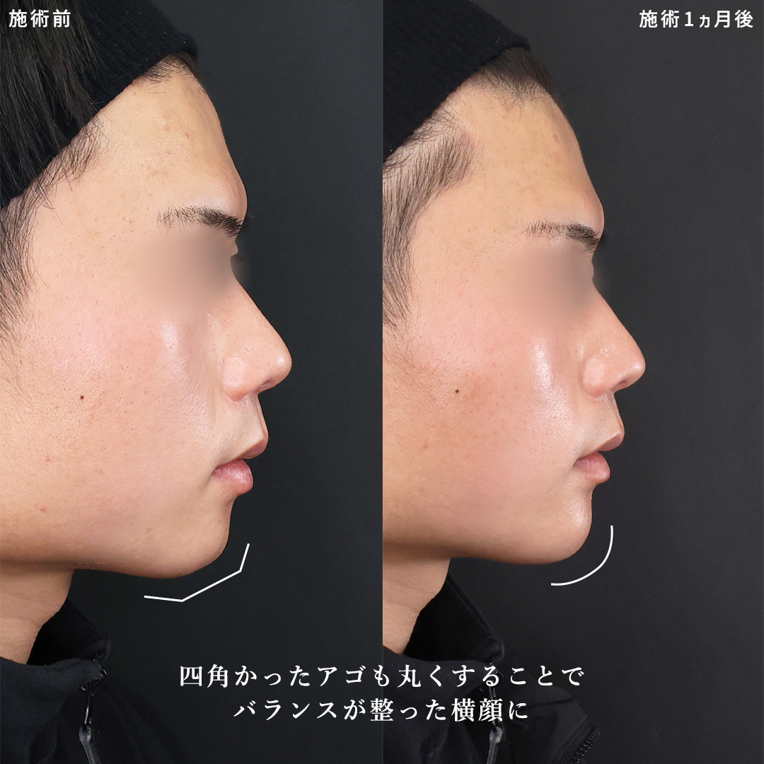 TAC式 ツヤ肌コラーゲンリフト®/エラボトックス注射/顎のヒアルロン酸注射の症例写真 施術前後 