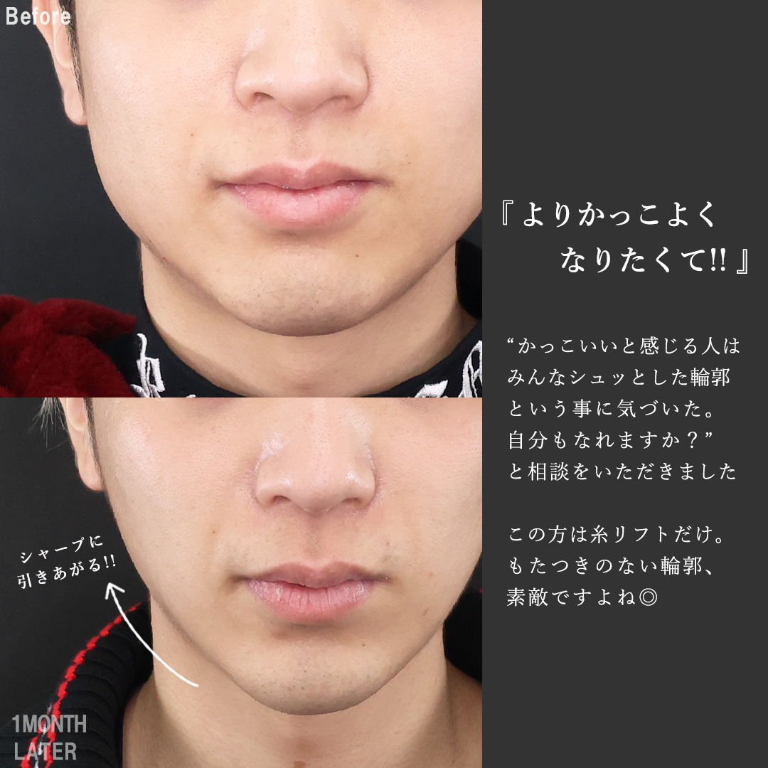 TAC式 ツヤ肌コラーゲンリフト®/ほうれい線のヒアルロン酸注射/顎のヒアルロン酸注射の症例写真 施術前後 