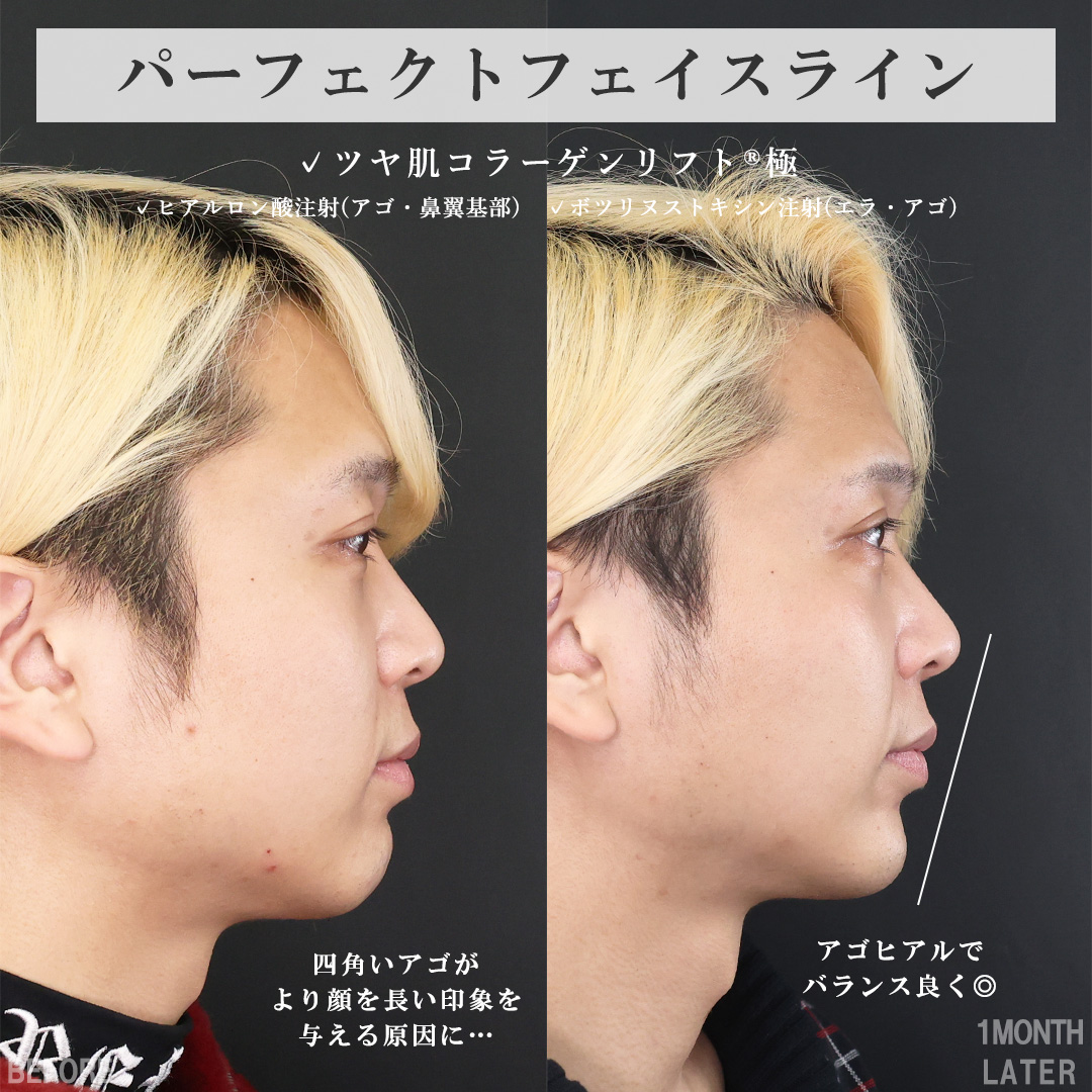 TAC式 ツヤ肌コラーゲンリフト®/ほうれい線のヒアルロン酸注射/顎のヒアルロン酸注射の症例写真 施術前後 