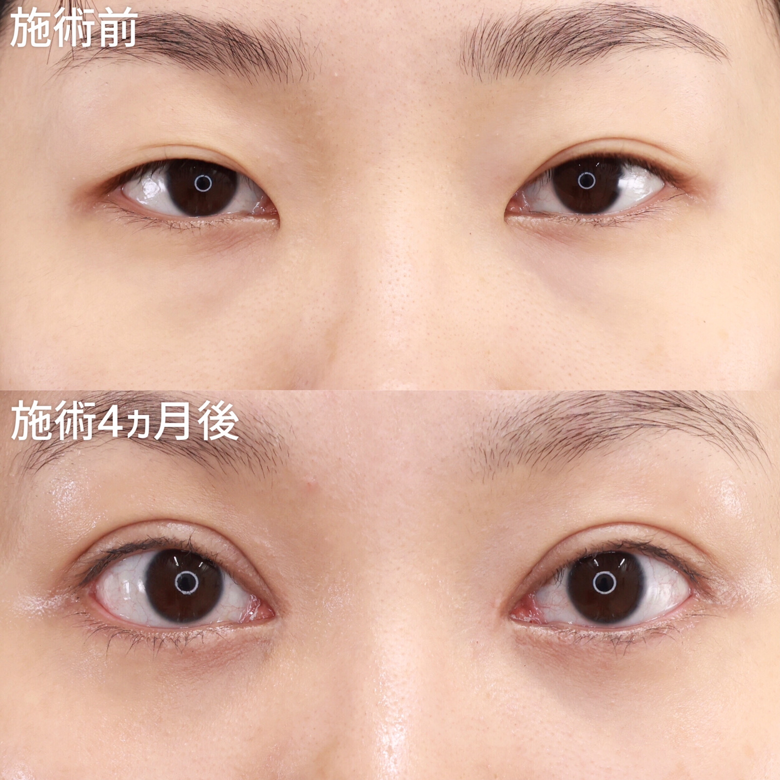 二重切開（全切開法）/目頭切開術/目尻切開術の症例写真 施術前後 