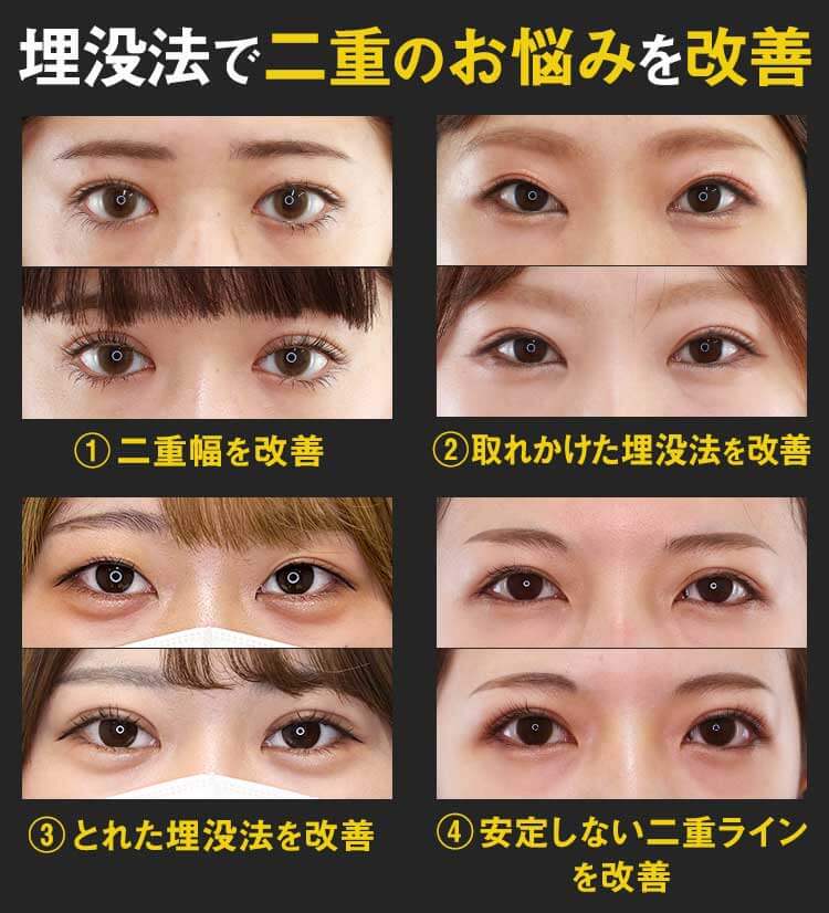 埋没法で二重のお悩みを改善①二重幅を改善②取れかけた埋没法を改善③とれた埋没法を改善④安定しない二重ラインを改善