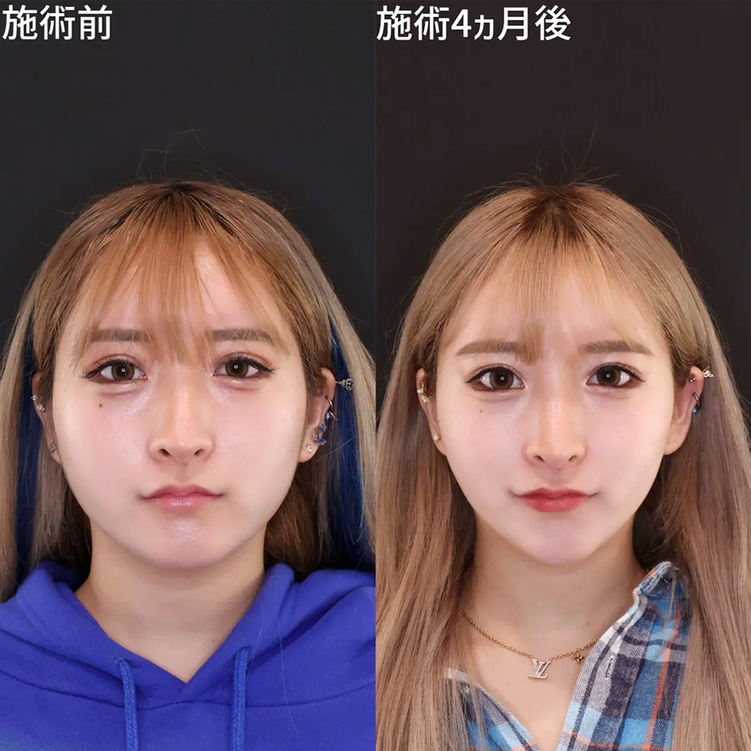 TAC式 ツヤ肌コラーゲンリフト®/ジョールファット除去の症例写真 施術前後 