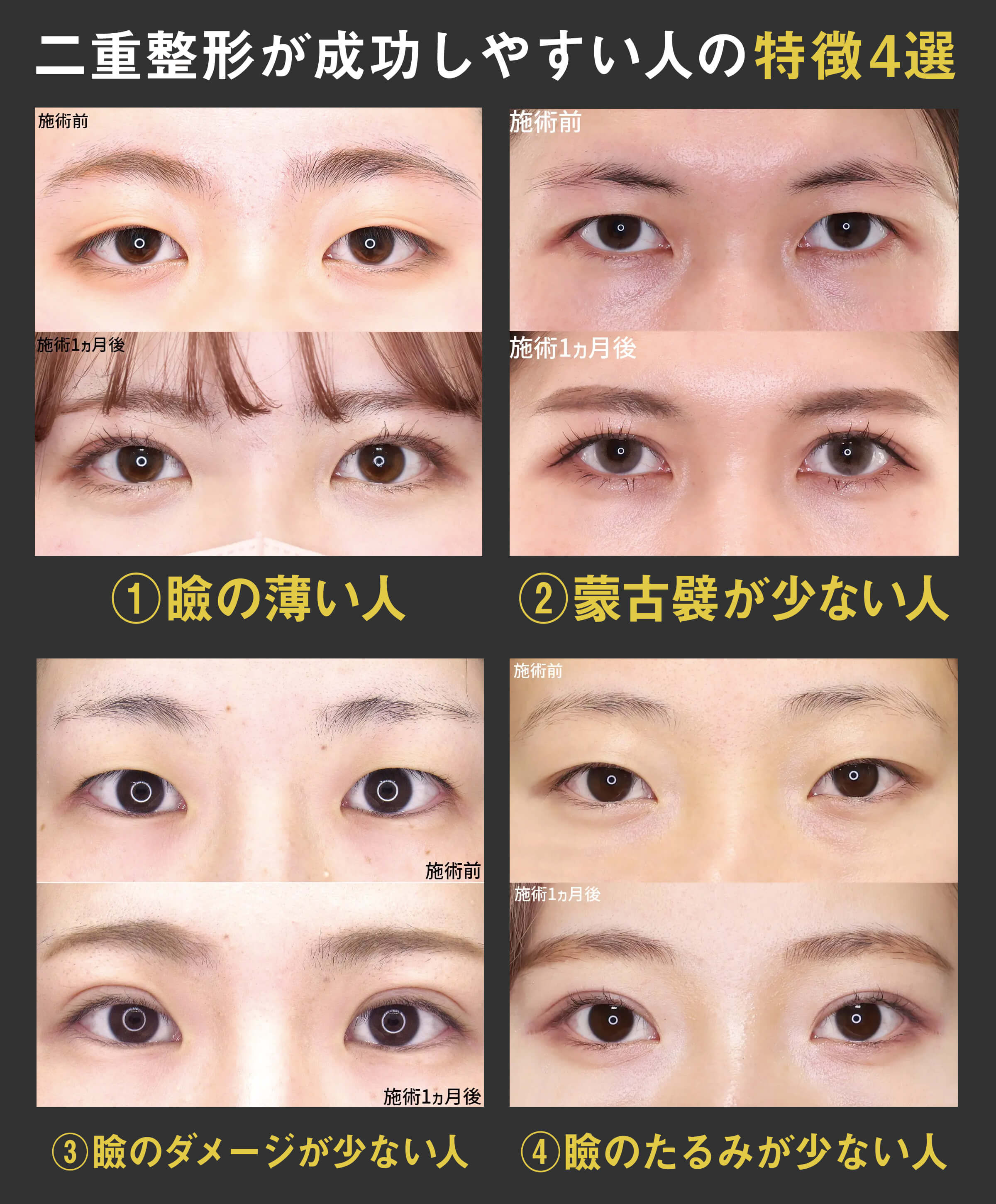 【症例写真】瞼が薄い人、蒙古ひだが比較的少ない人、瞼にダメージを受けていない人、瞼のたるみが少ない人