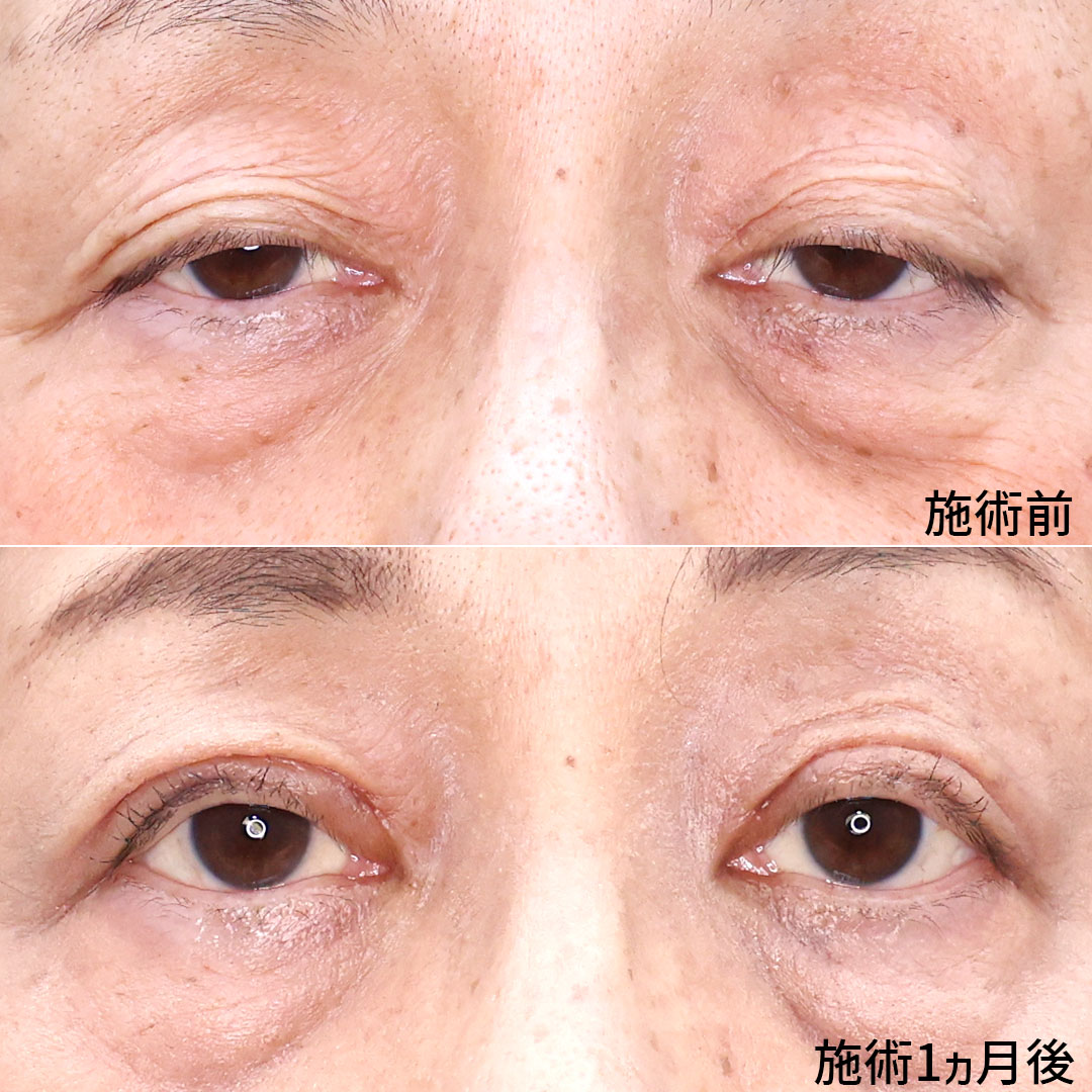 上眼瞼切開術/眼瞼下垂（目つき矯正）の症例写真 施術前後 