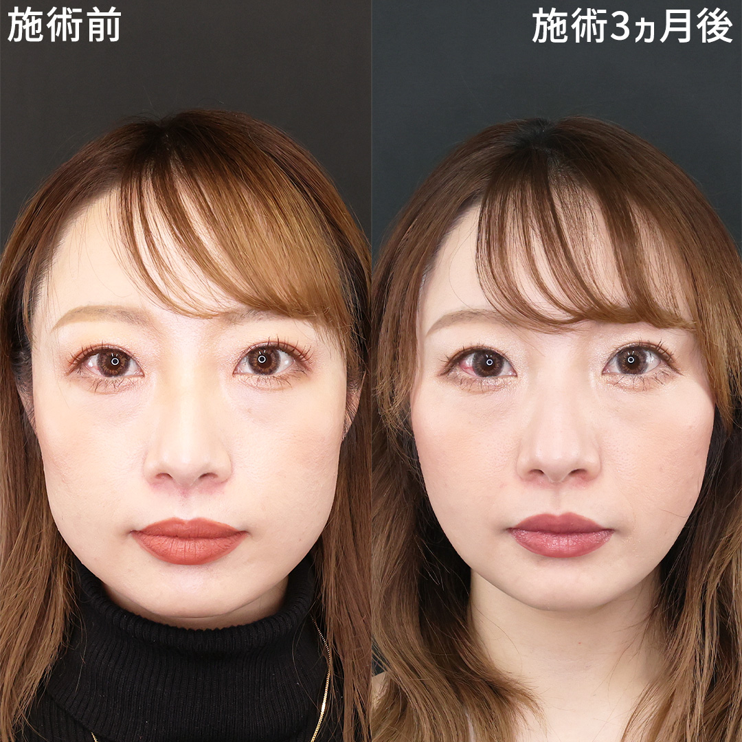 小顔整形｜パーフェクトフェイスライン/TAC式 ツヤ肌コラーゲンリフト®/ジョールファット除去の症例写真 施術前後 