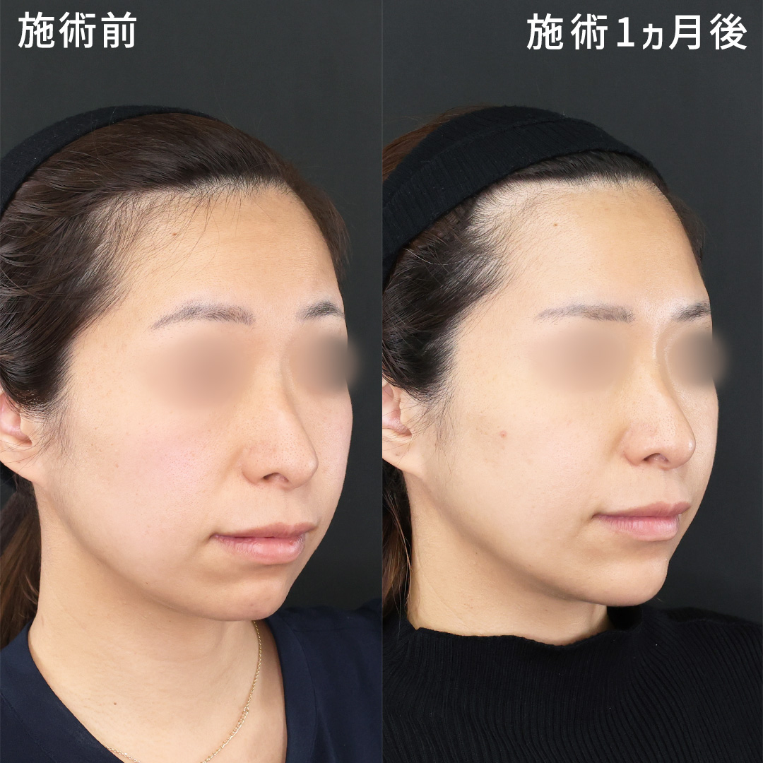 TAC式 ツヤ肌コラーゲンリフト®/TAC式 ショッピングリフト/顎のヒアルロン酸注射の症例写真 施術前後 