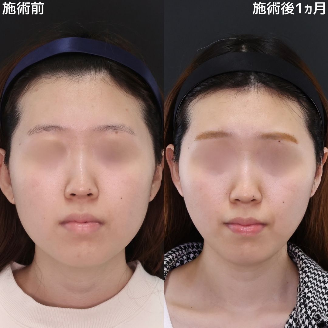 TAC式 ツヤ肌コラーゲンリフト®の症例写真 施術前後 