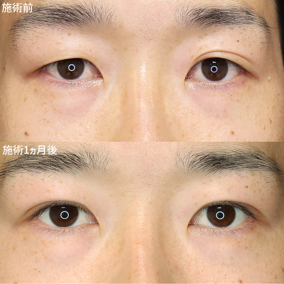 二重埋没法の症例写真 施術前後 