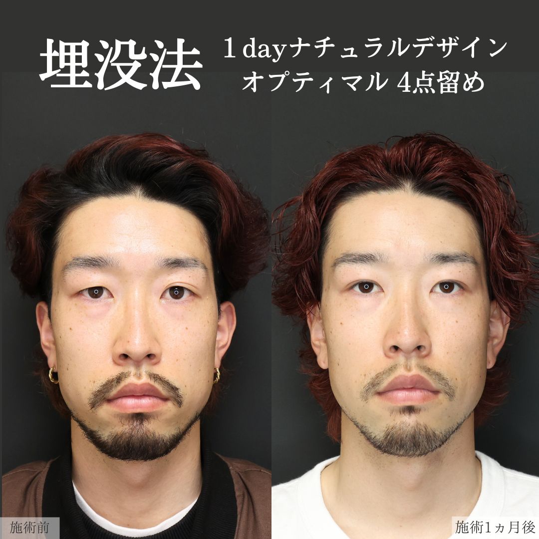 二重埋没法の症例写真 施術前後 