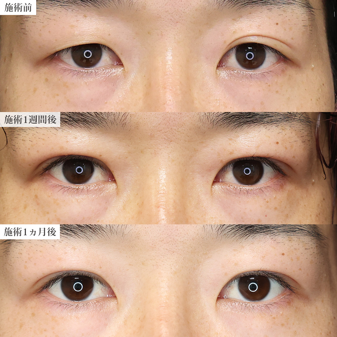 二重埋没法の症例写真 施術前後 