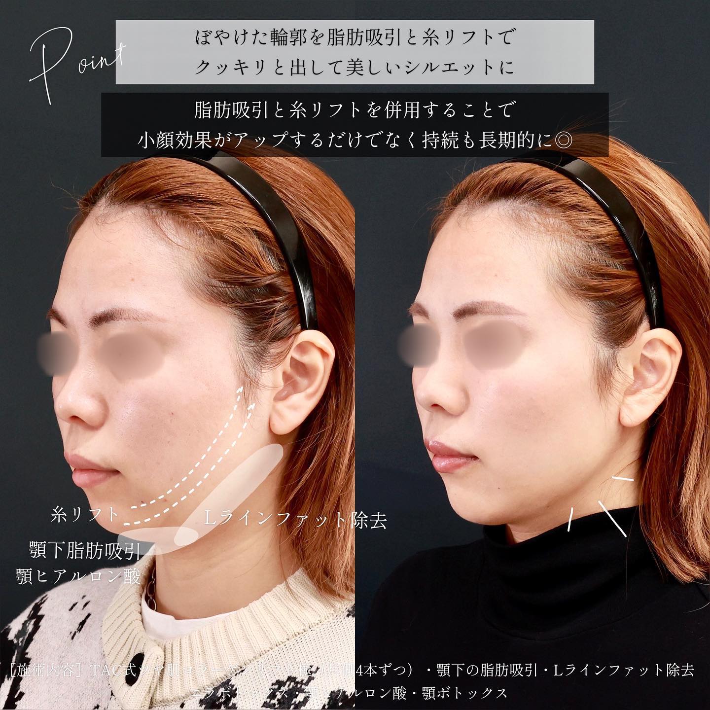 小顔整形｜パーフェクトフェイスライン/TAC式 ツヤ肌コラーゲンリフト®/顎下の脂肪吸引の症例写真 施術前後 