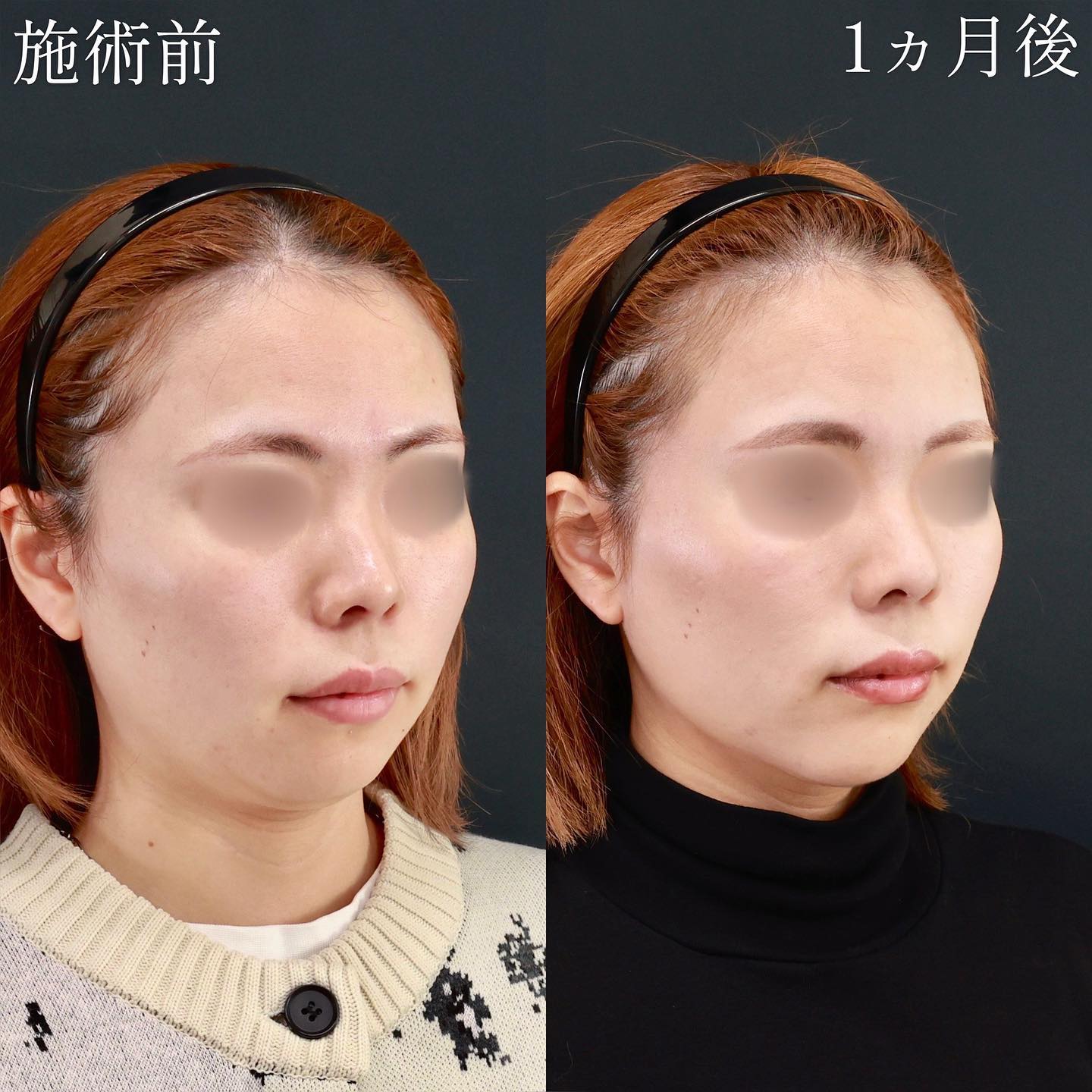 小顔整形｜パーフェクトフェイスライン/TAC式 ツヤ肌コラーゲンリフト®/顎下の脂肪吸引の症例写真 施術前後 