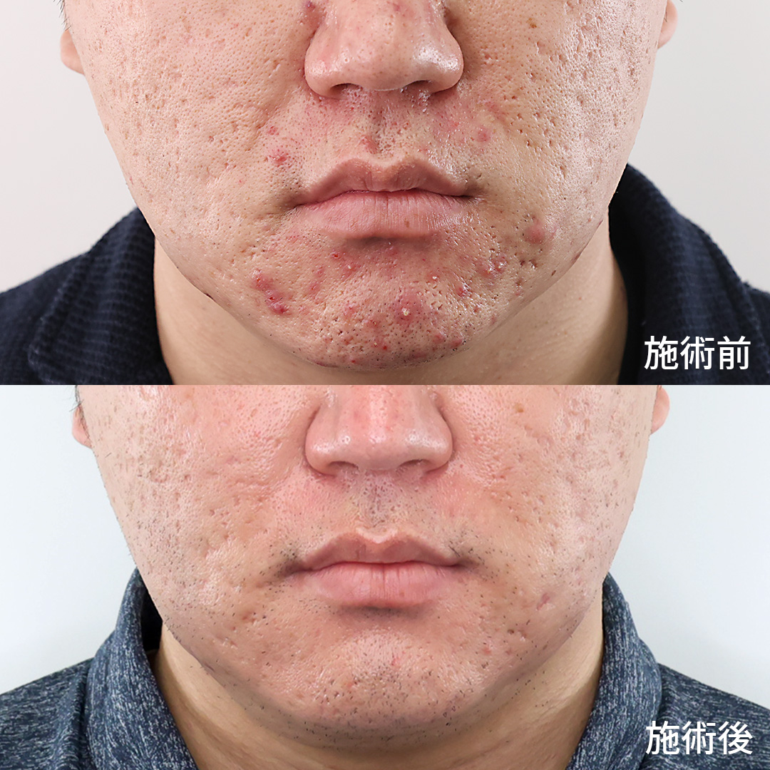 ヴァンパイアフェイシャルの症例写真 施術前後 