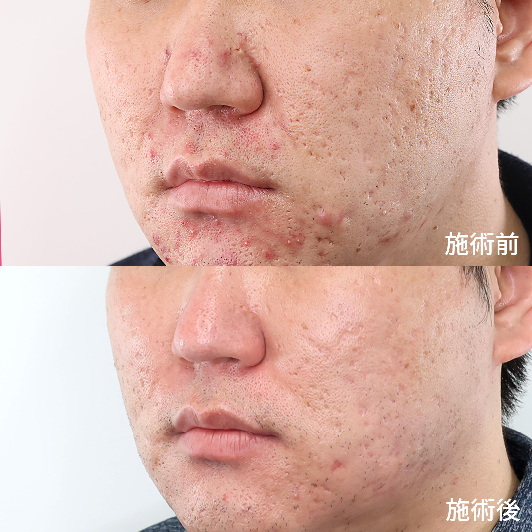 ヴァンパイアフェイシャルの症例写真 施術前後 