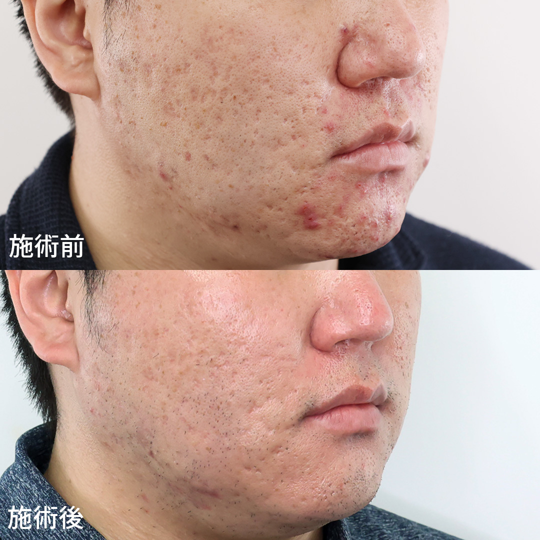 ヴァンパイアフェイシャルの症例写真 施術前後 