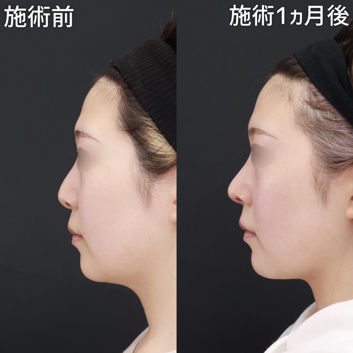 鼻先軟骨移植/鼻尖形成・鼻尖縮小/鼻：その他の症例写真 施術前後 
