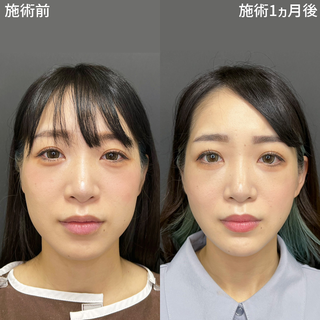TAC式 ツヤ肌コラーゲンリフト®/バッカルファット除去/ジョールファット除去の症例写真 施術前後 