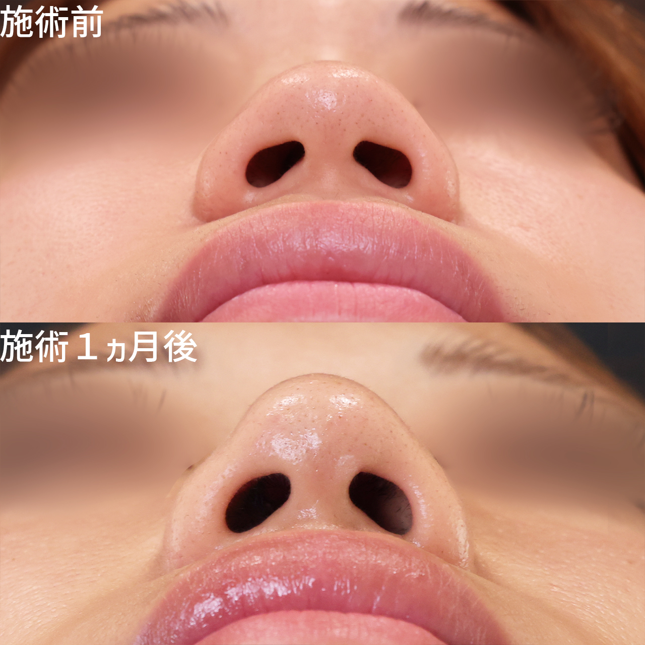 鼻尖形成・鼻尖縮小/鼻のヒアルロン酸注射の症例写真 施術前後 