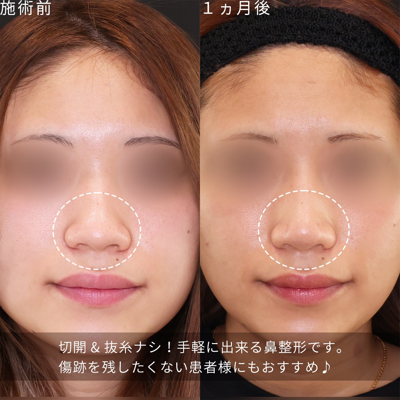 鼻尖形成・鼻尖縮小/鼻のヒアルロン酸注射の症例写真 施術前後 