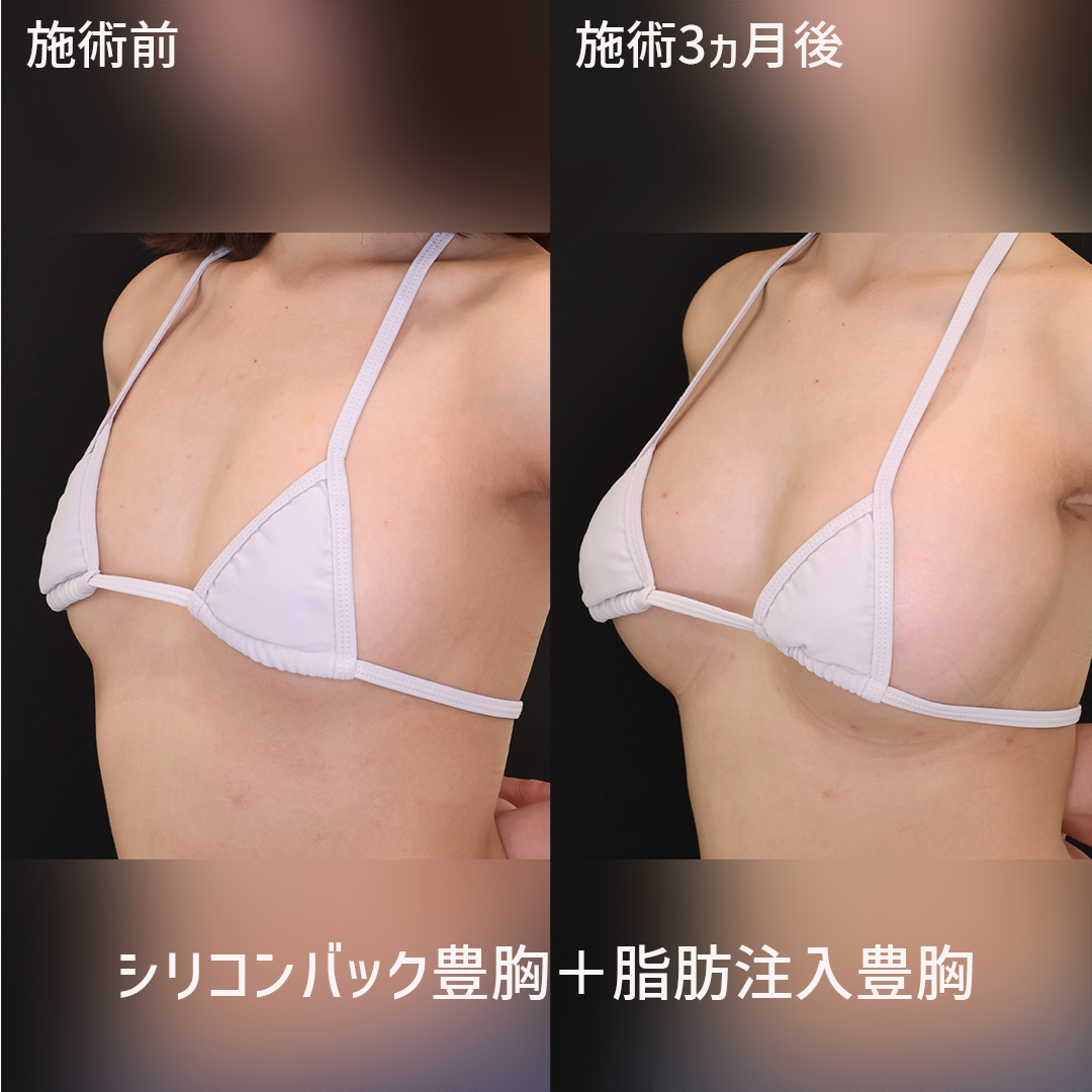 シリコンバッグ豊胸（人工乳腺バッグ）/脂肪注入豊胸（コンデンスリッチ・ピュアグラフト・１day脂肪豊胸）の症例写真 施術前後 
