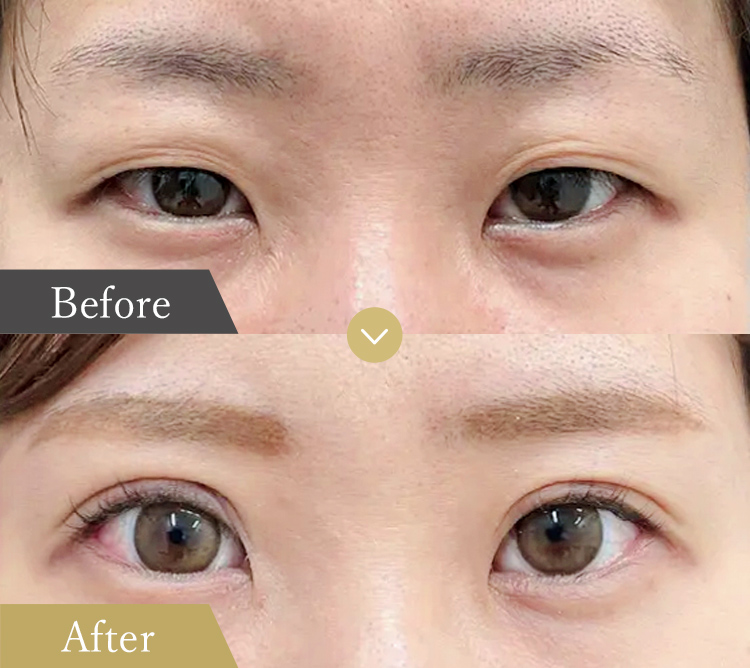 重いまぶたを解消 眼瞼下垂の症例写真