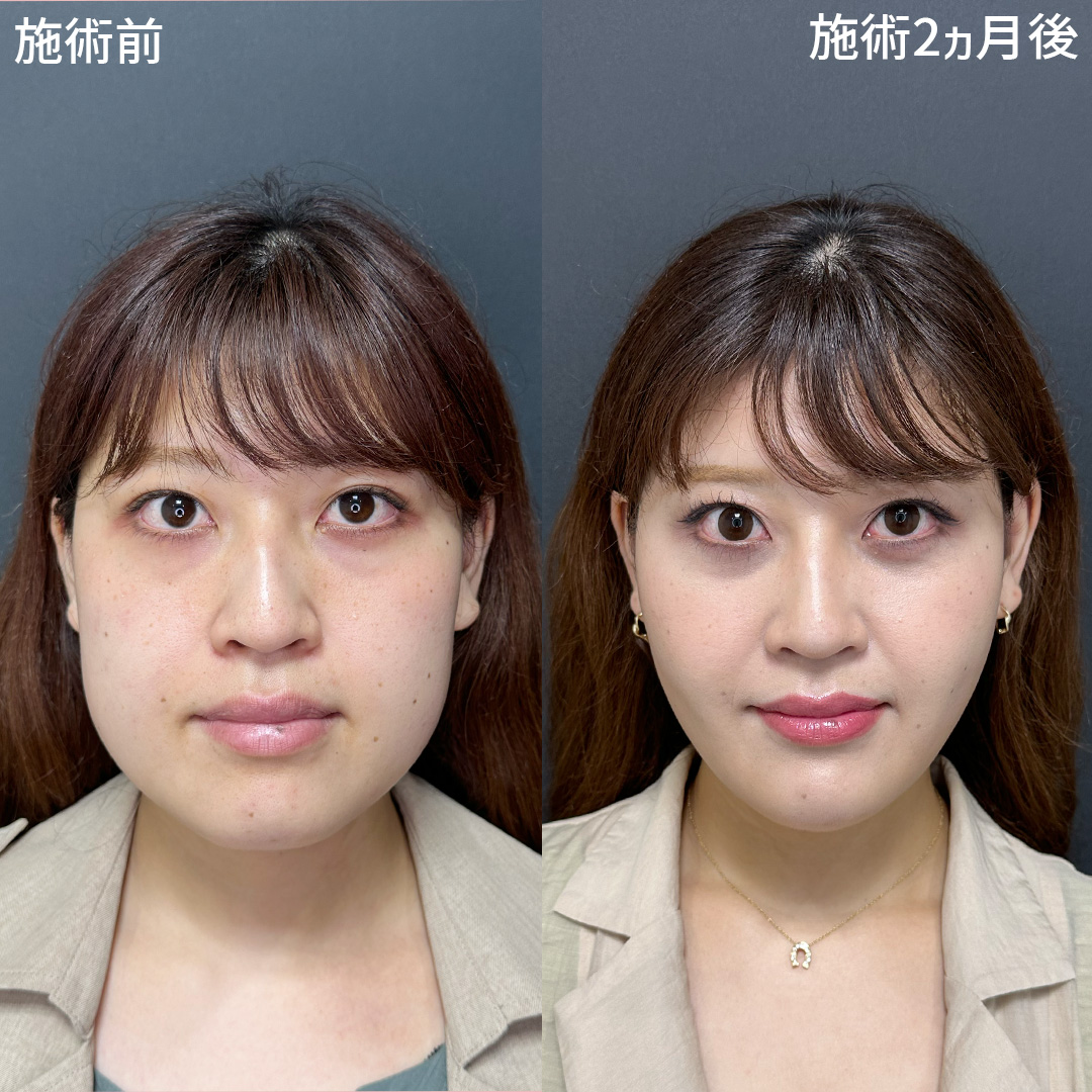 《予約殺到》マリエ先生の小顔整形