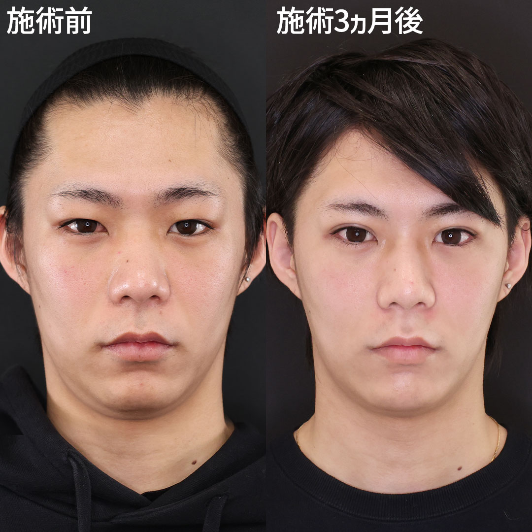 Lラインファット除去（エラ下脂肪除去）/クイックコスメリング/TAC式 ツヤ肌コラーゲンリフト®の症例写真 施術前後 