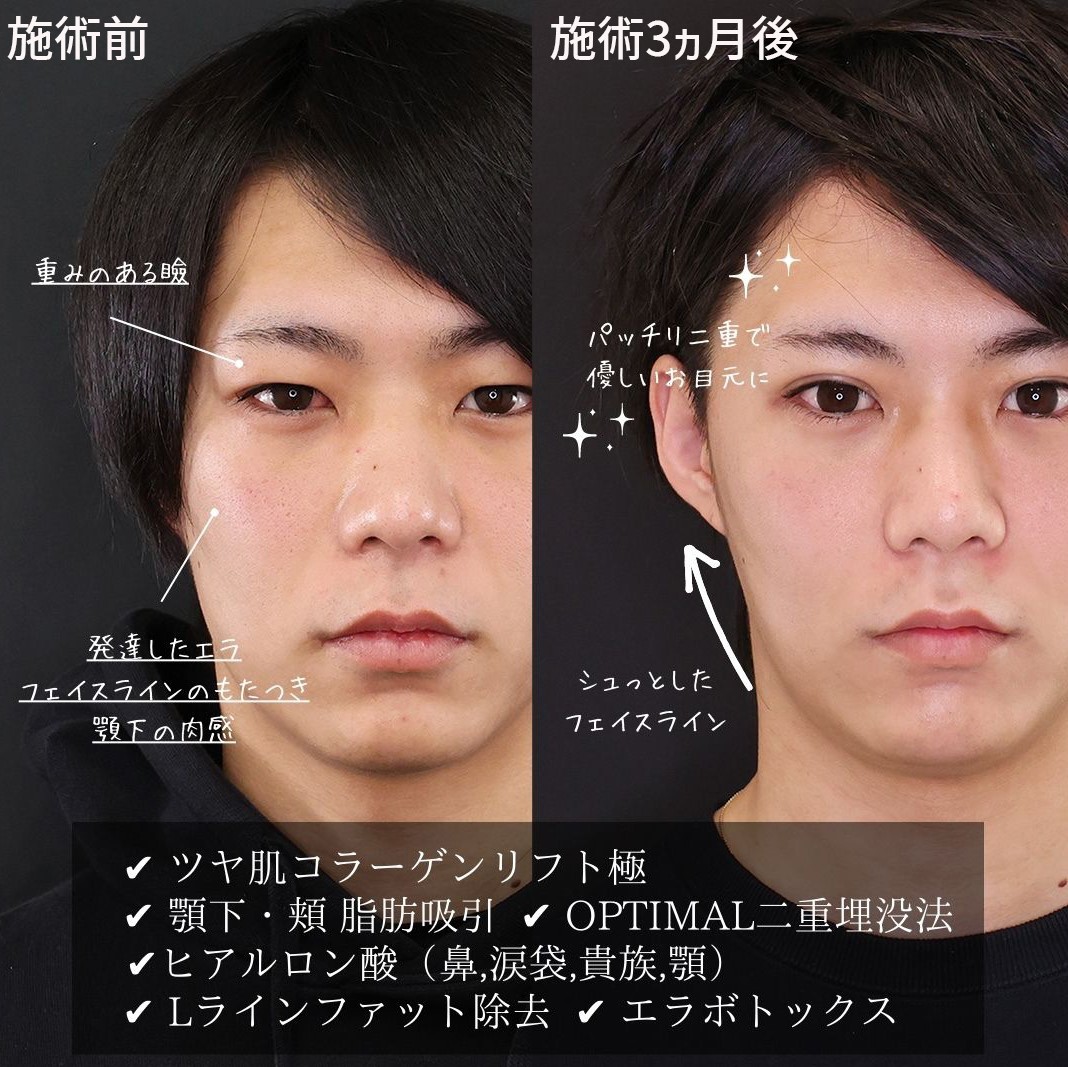 Lラインファット除去（エラ下脂肪除去）/クイックコスメリング/TAC式 ツヤ肌コラーゲンリフト®の症例写真 施術前後 
