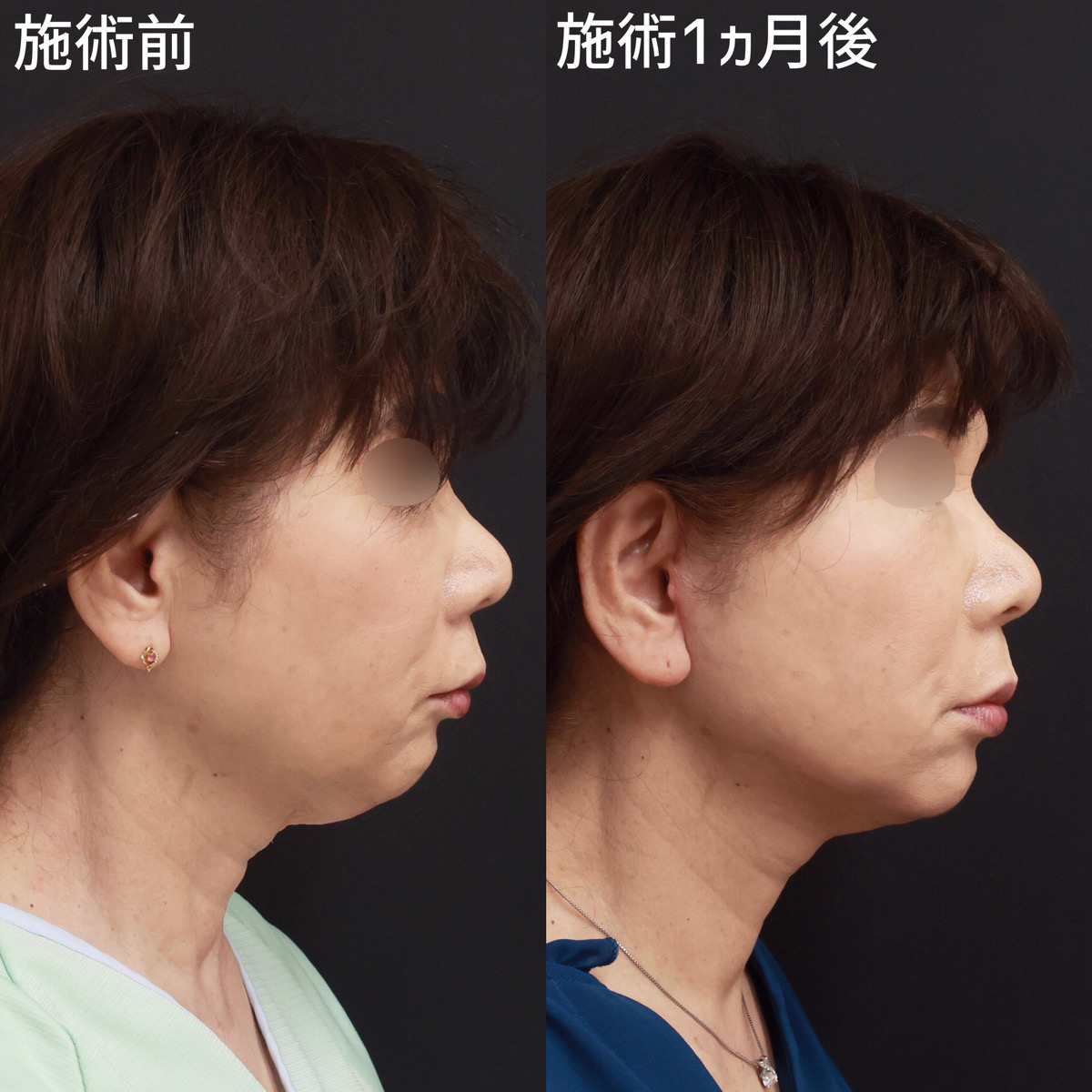 フェイスリフト（切開）の症例写真 施術前後 