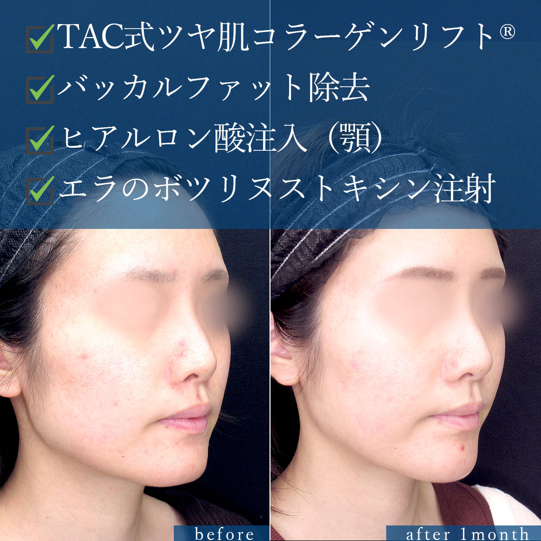 TAC式 ツヤ肌コラーゲンリフト®/バッカルファット除去/エラボトックス注射の症例写真 施術前後 