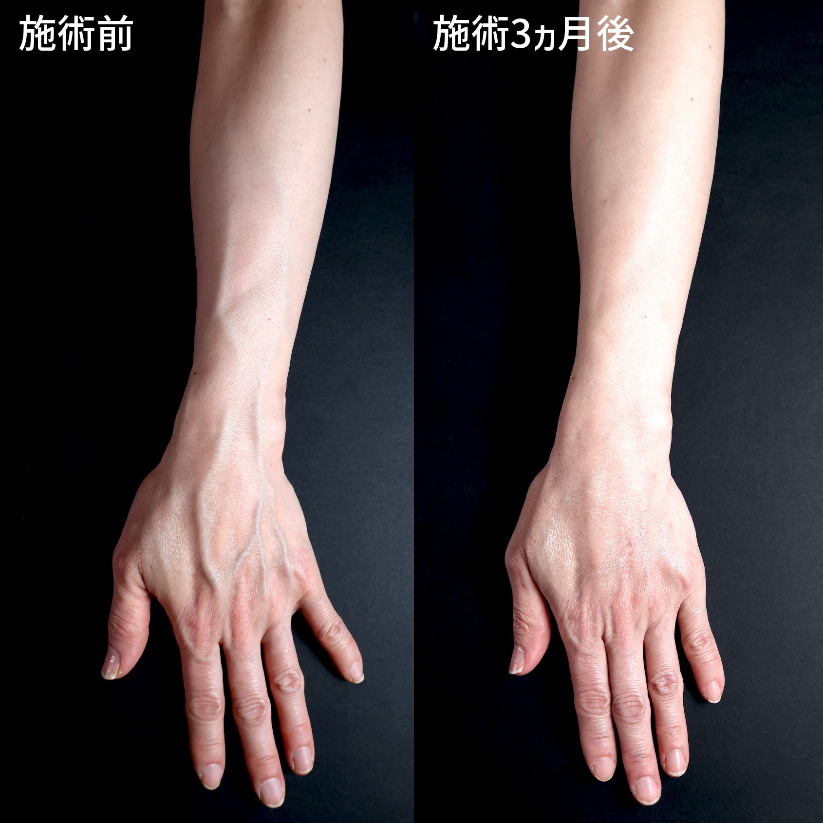 ハンドベイン（手のアンチエイジング・血管治療）の症例写真 施術前後 