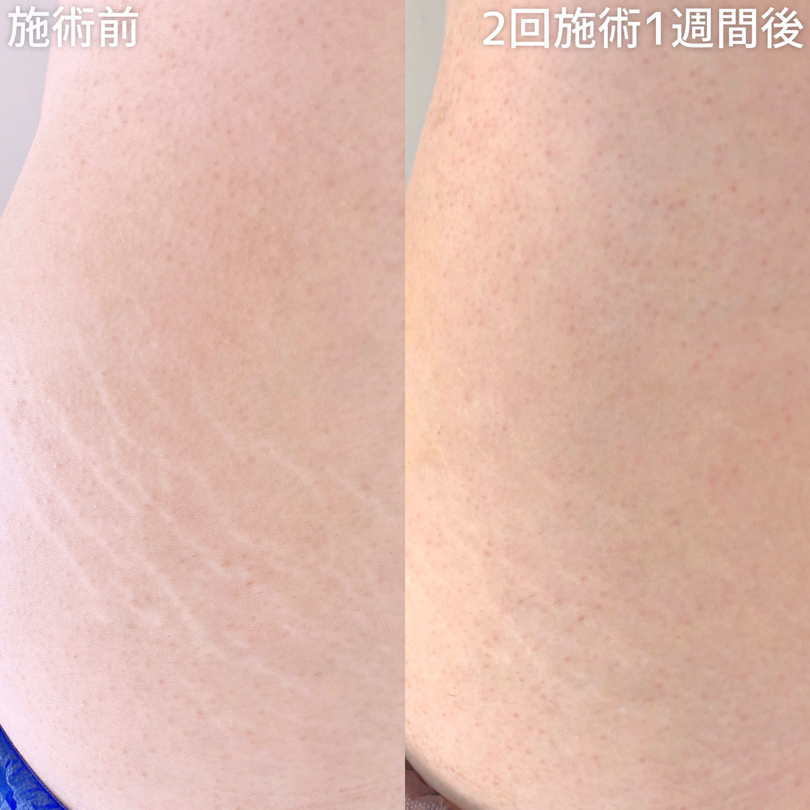アートメイクSkin52（妊娠線・肉割れ・ストレッチマーク・リスカ跡・傷跡修正）の症例写真 施術前後 