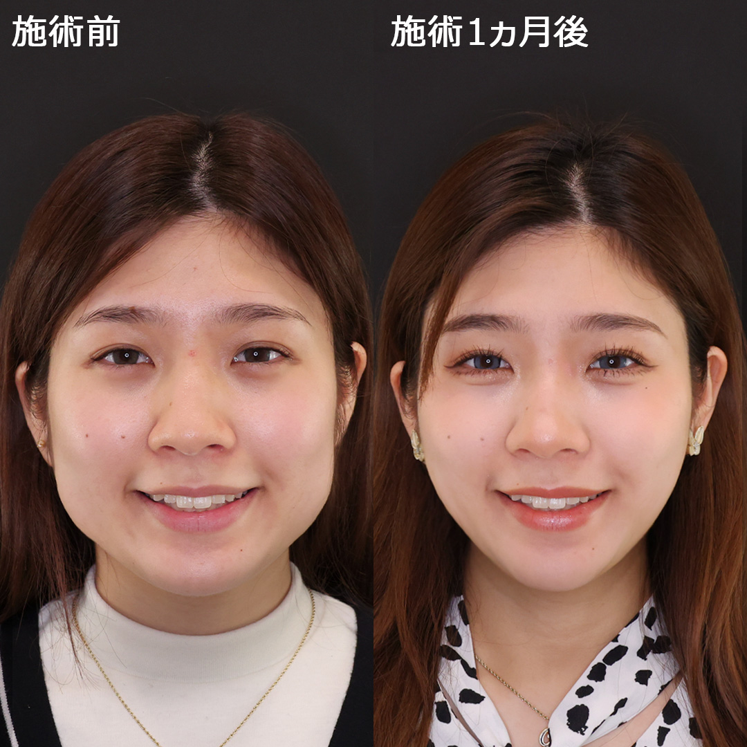 アイドルフェイスに大変身！【小顔複合施術】