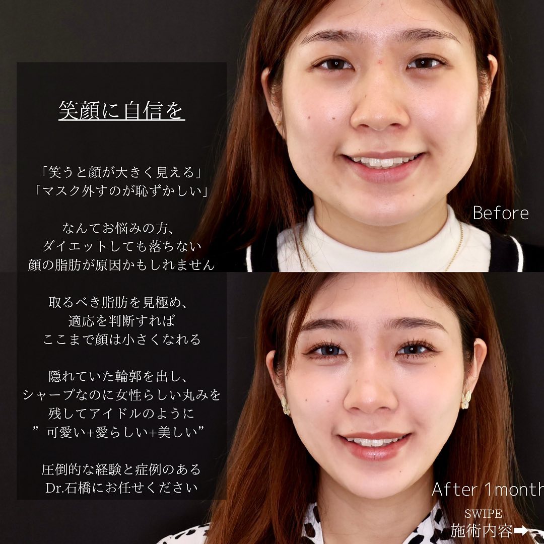 TAC式 ツヤ肌コラーゲンリフト®/バッカルファット除去/Lラインファット除去（エラ下脂肪除去）の症例写真 施術前後 