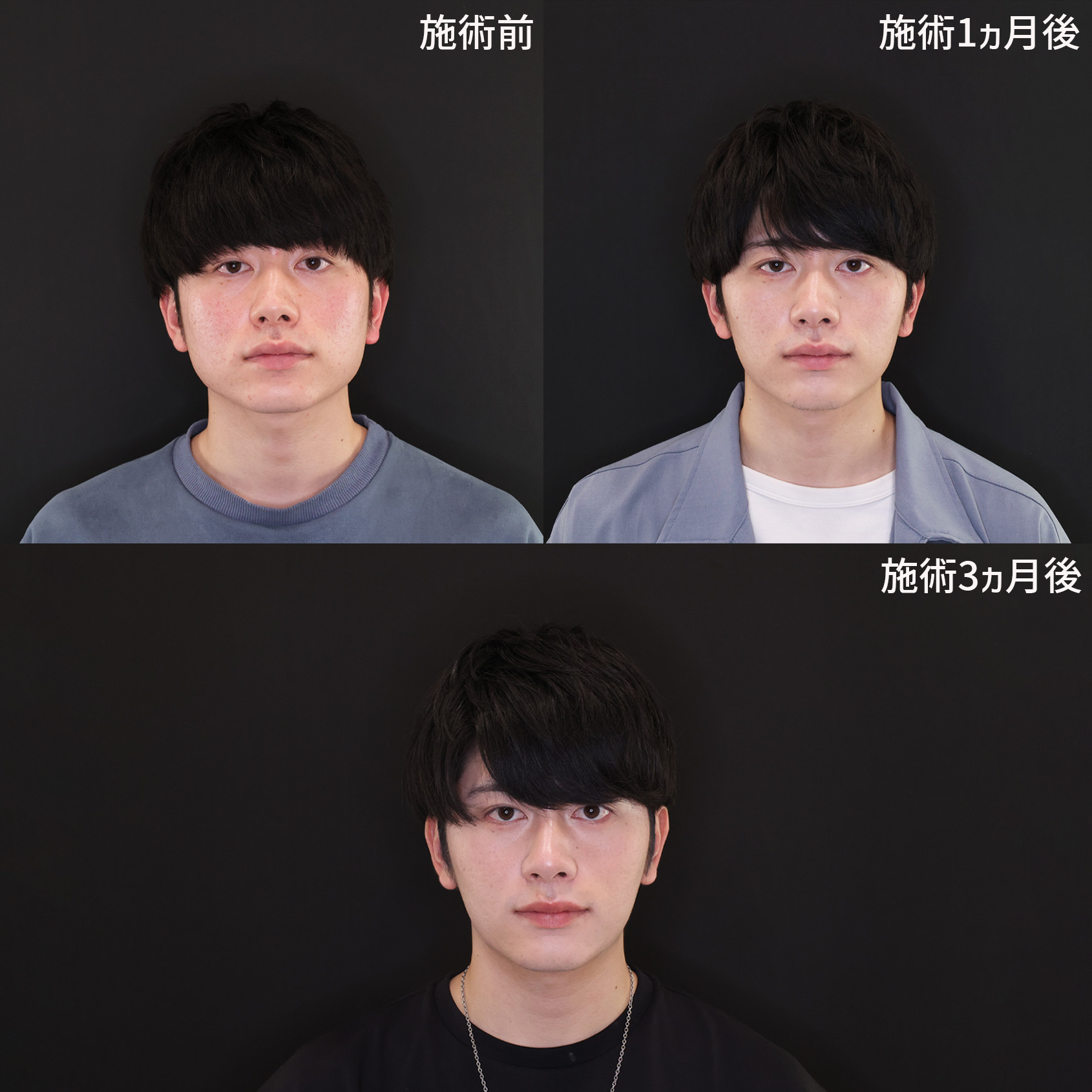 TAC式 ツヤ肌コラーゲンリフト®/ジョールファット除去/エラボトックス注射の症例写真 施術前後 