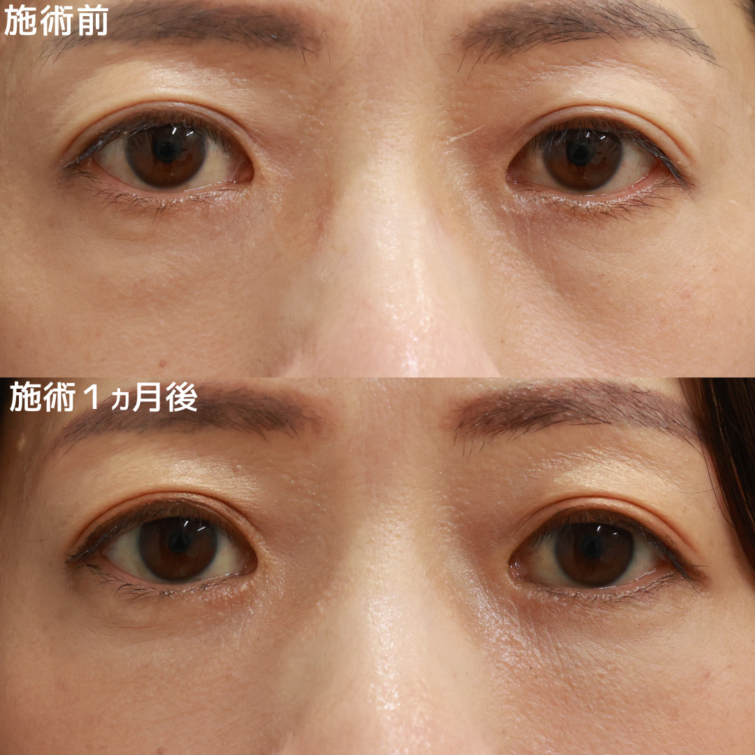 下眼瞼脱脂術（目の下のたるみ取り・目の下の脂肪ふくらみ取り）/顔の脂肪注入(コンデンスリッチフェイス)の症例写真 施術前後 