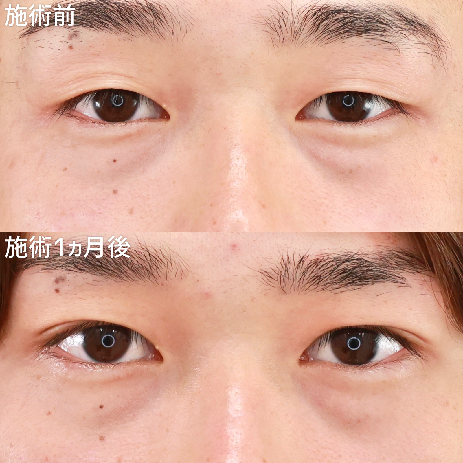 二重埋没法の症例写真 施術前後 