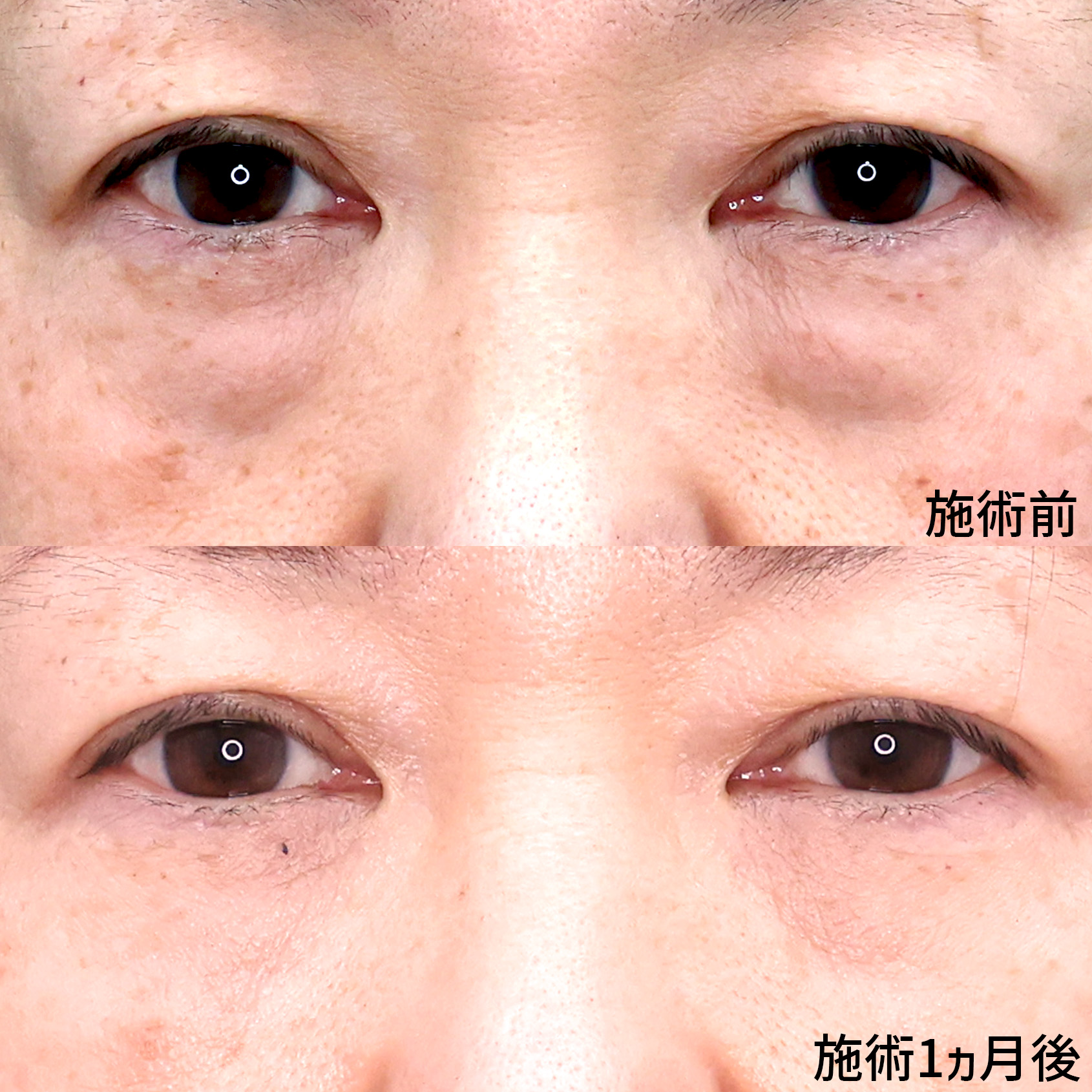 下眼瞼脱脂術（目の下のたるみ取り・目の下の脂肪ふくらみ取り）/目の下のヒアルロン酸注射の症例写真 施術前後 