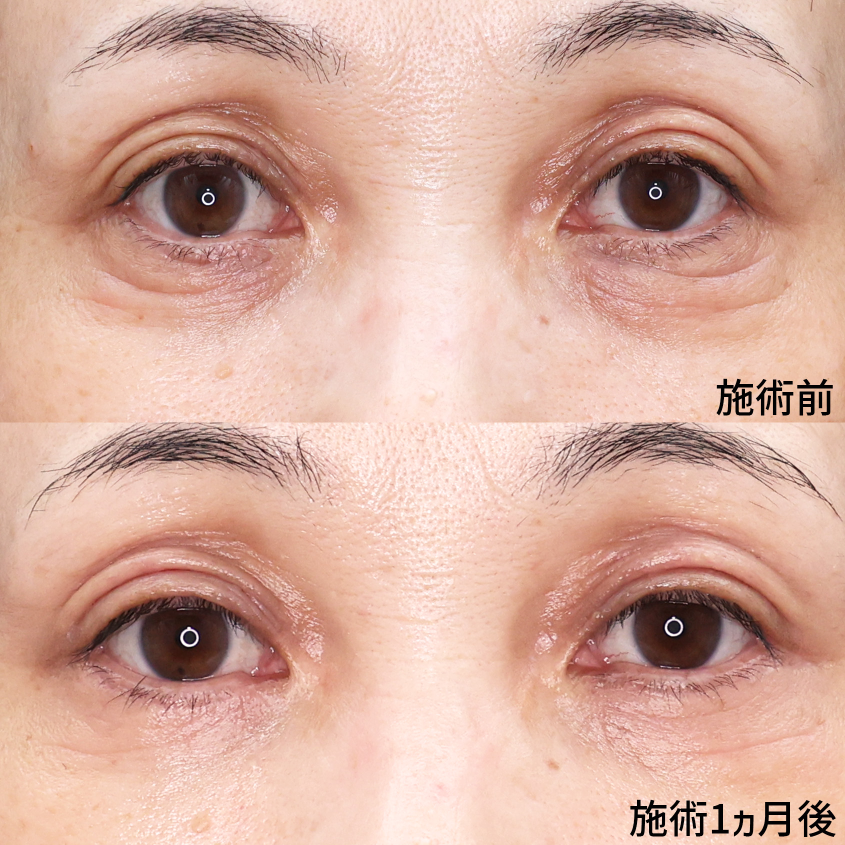 下眼瞼切開術（クマ・たるみとり）/下眼瞼脱脂術（目の下のたるみ取り・目の下の脂肪ふくらみ取り）の症例写真 施術前後 
