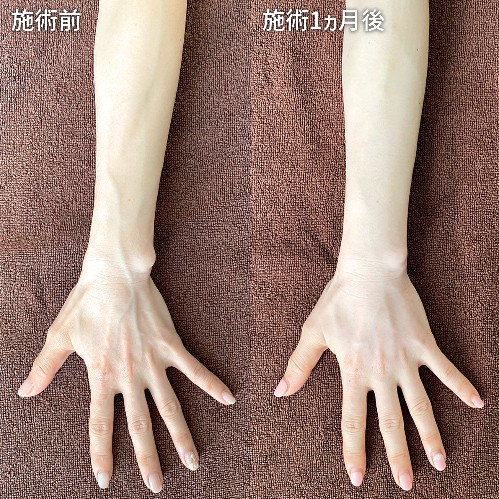ハンドベイン（手のアンチエイジング・血管治療）の症例写真 施術前後 