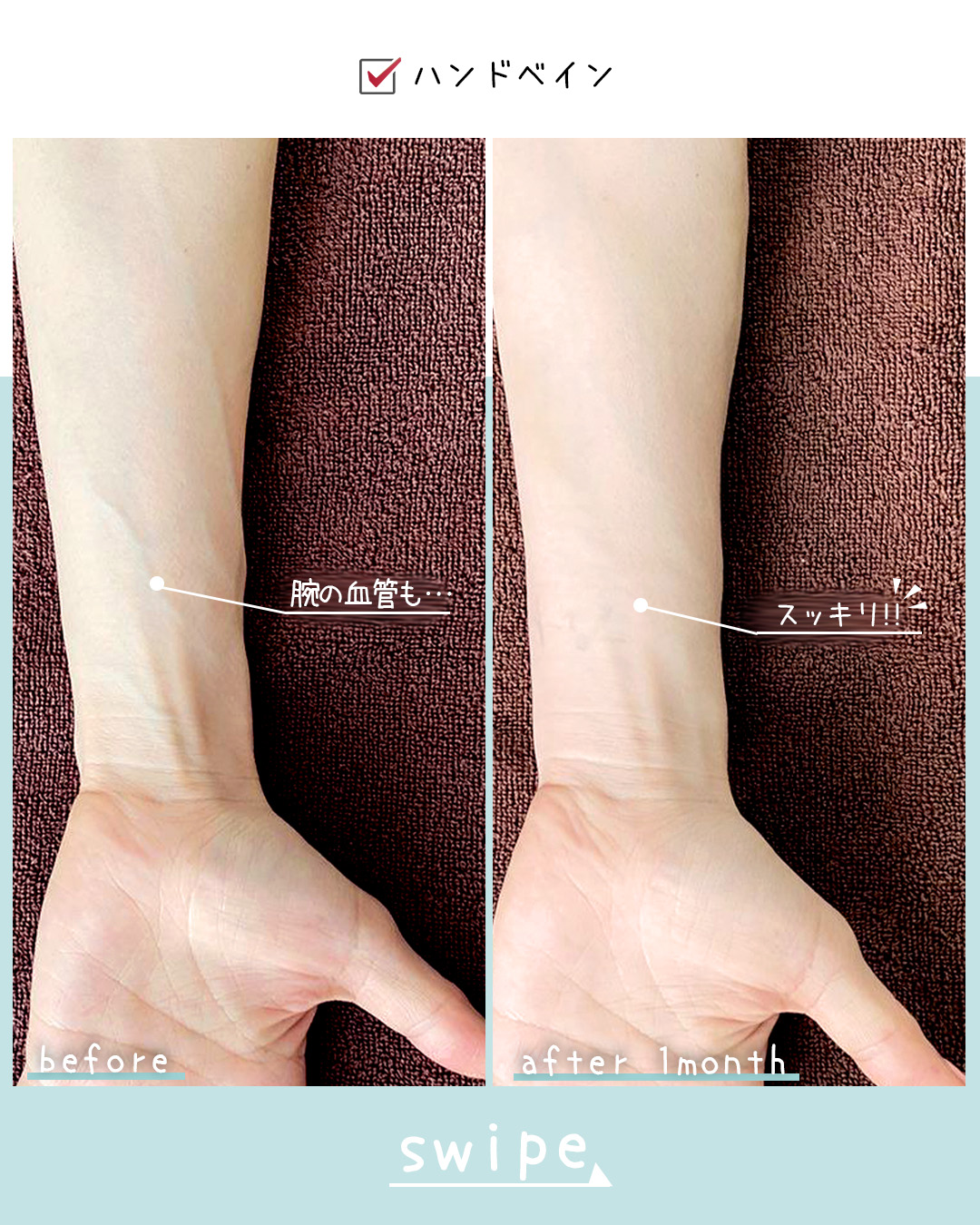 ハンドベイン（手のアンチエイジング・血管治療）の症例写真 施術前後 