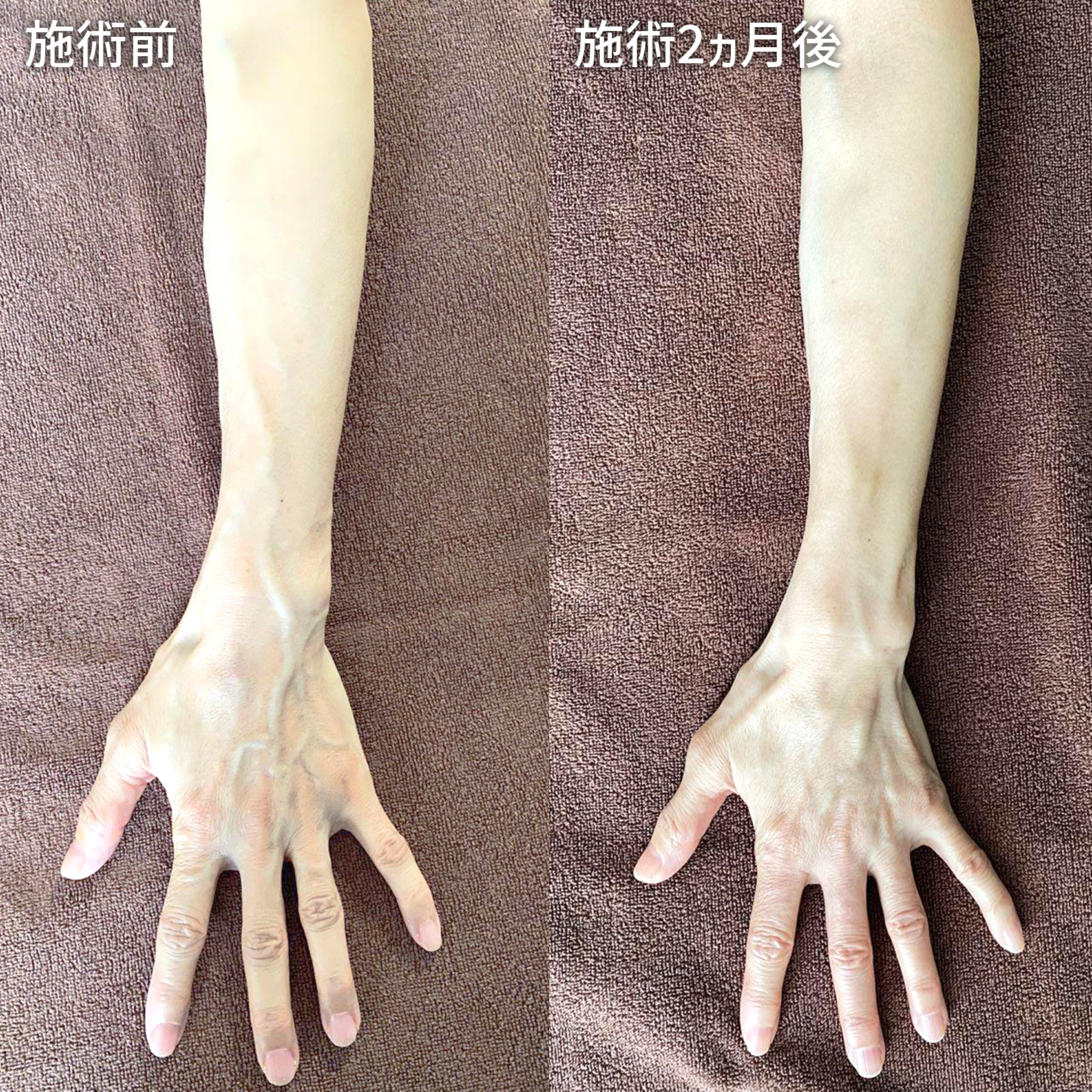 ハンドベイン（手のアンチエイジング・血管治療）の症例写真 施術前後 