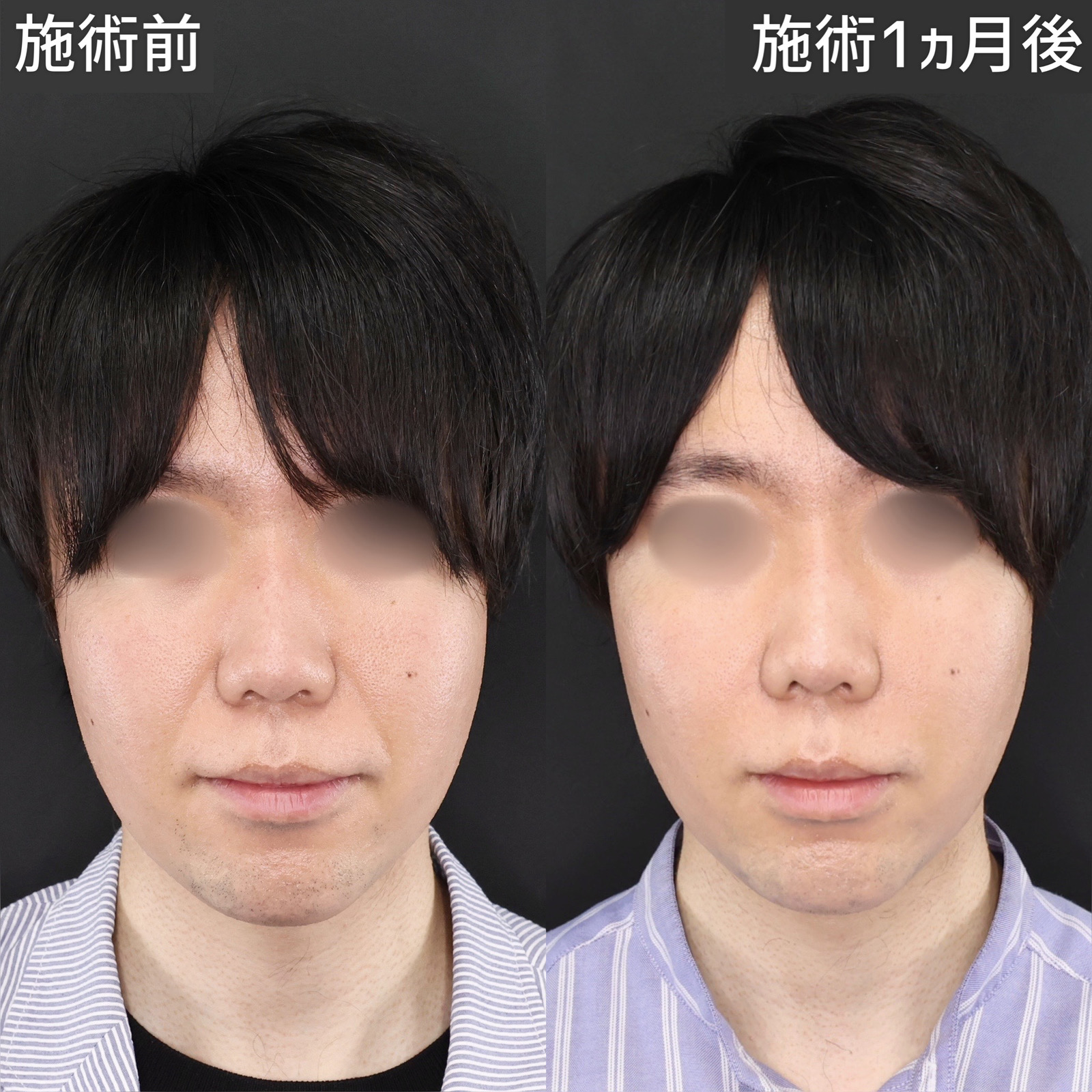 貴族手術（鼻翼基部プロテーゼ・脂肪注入・粉砕肋軟骨移植）の症例写真 施術前後 
