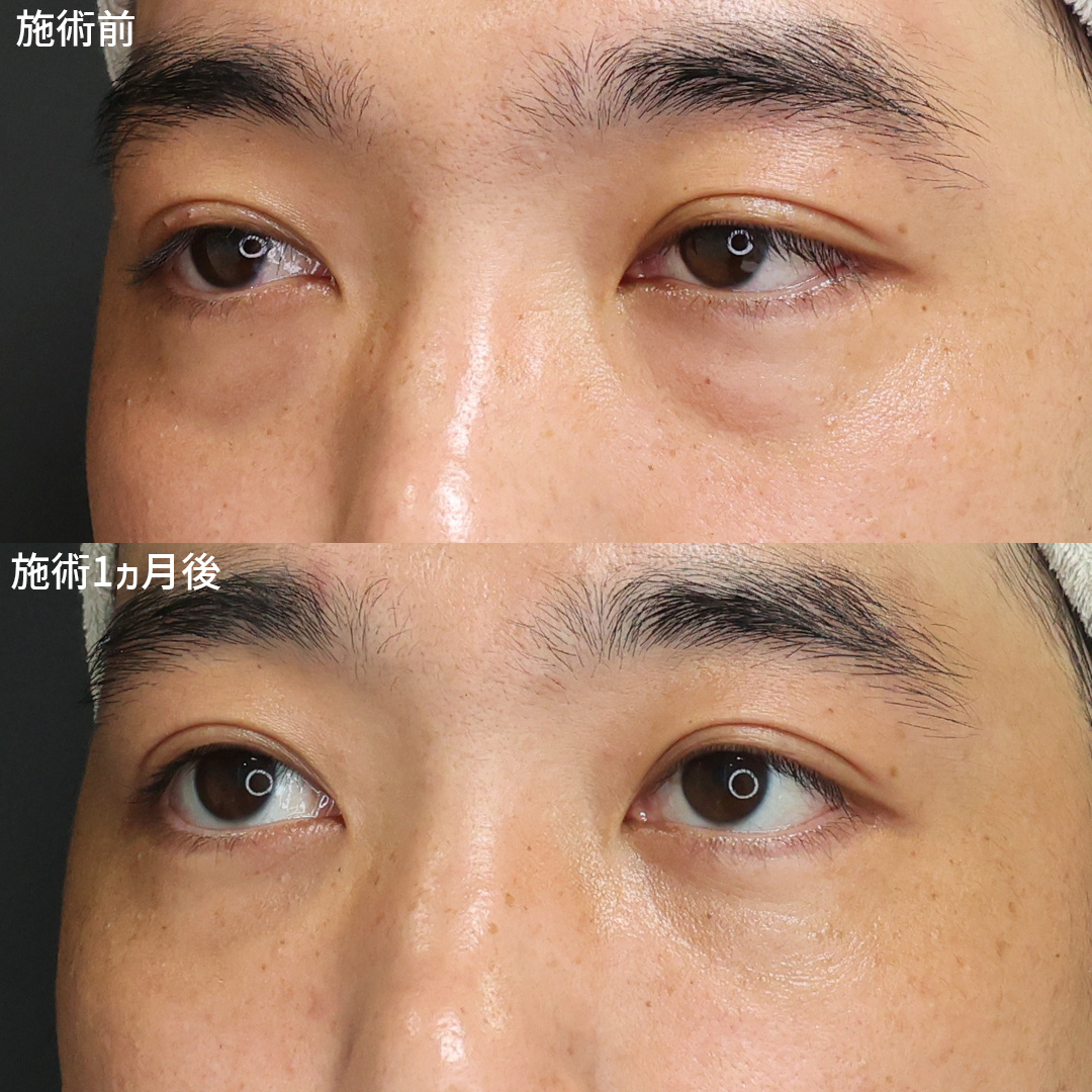 下眼瞼脱脂術（目の下のたるみ取り・目の下の脂肪ふくらみ取り）の症例写真 施術前後 