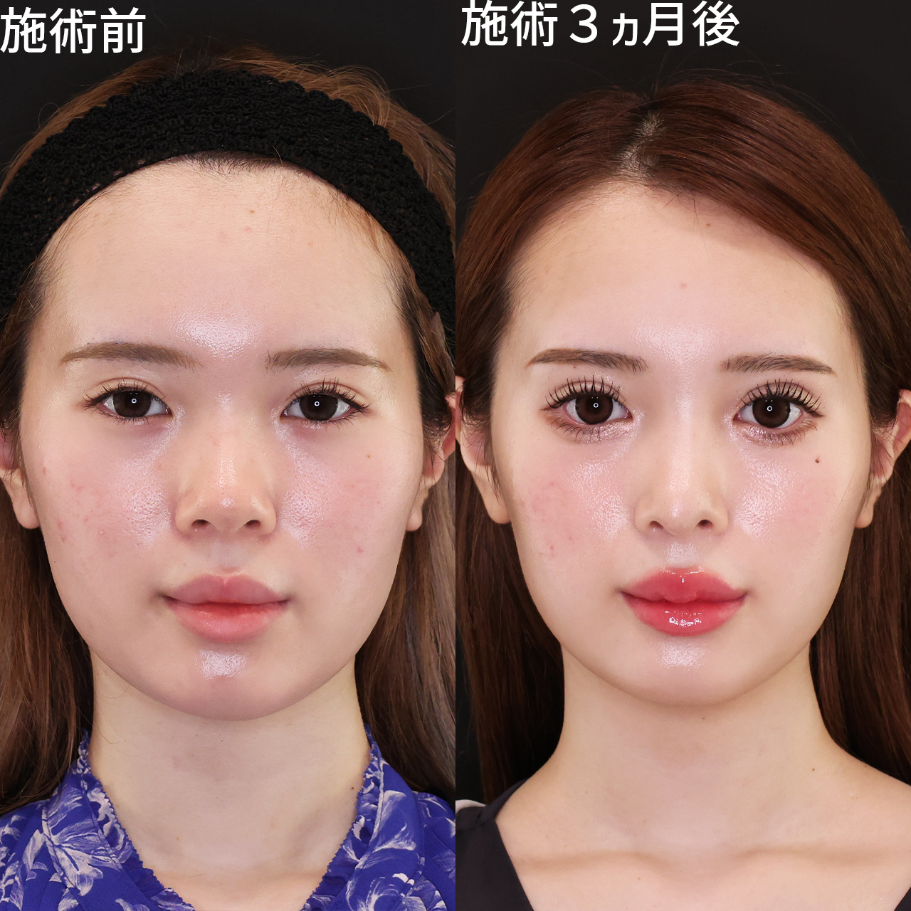 鼻中隔延長術/鼻先軟骨移植/鼻尖形成・鼻尖縮小の症例写真 施術前後 
