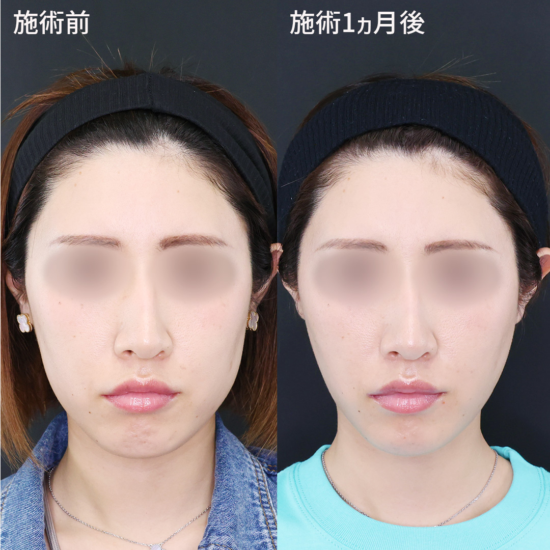 TAC式 ツヤ肌コラーゲンリフト®/TAC式 ショッピングリフト/エラボトックス注射の症例写真 施術前後 
