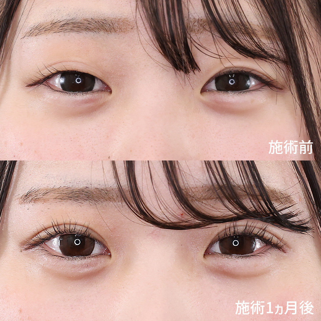 二重埋没法の症例写真 施術前後 