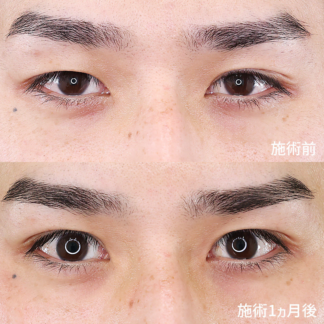 片目二重術（片目だけ整形したい方）/二重埋没法の症例写真 施術前後 